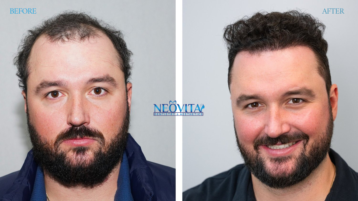 Hair transplant — before and after, NEOVITA patient