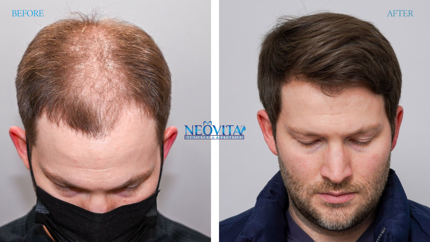 Hair transplant — before and after, NEOVITA patient