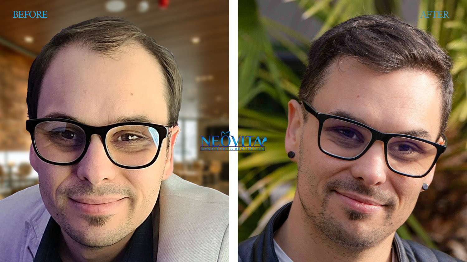 Hair transplant — before and after, NEOVITA patient