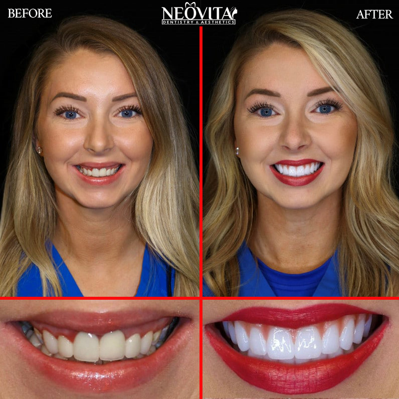 Dental treatment — before and after, NEOVITA patient